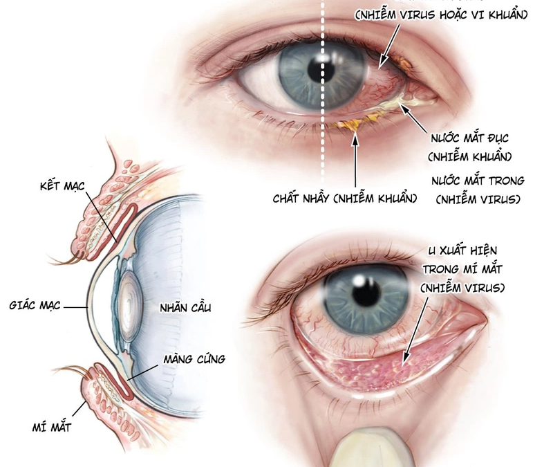 Những điều cần biết về bệnh đau mắt đỏ ở trẻ em